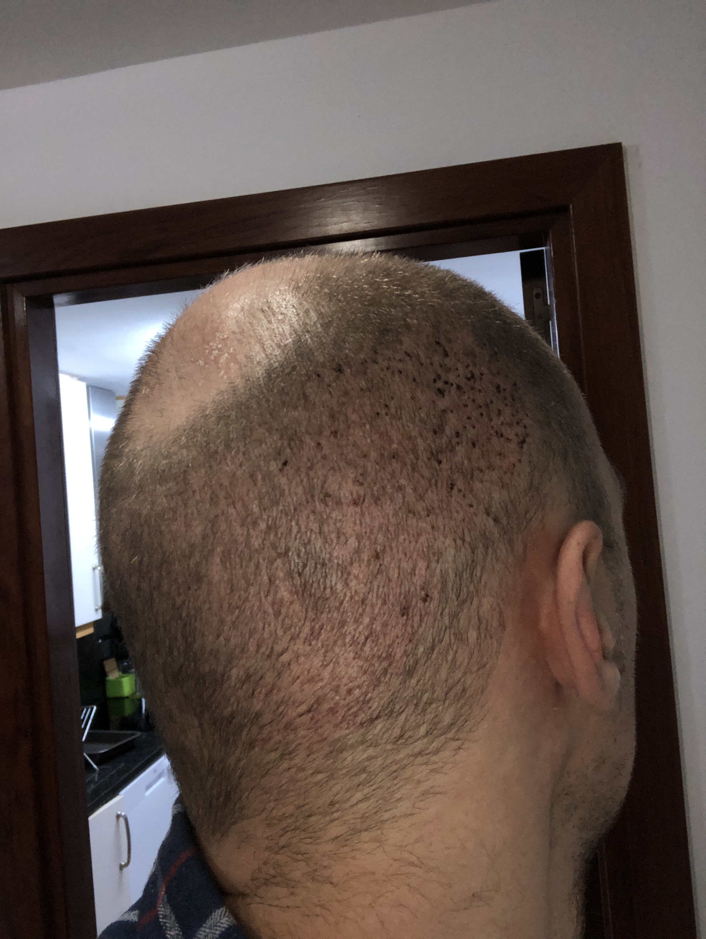 Hair transplant, day 12 | Paul Jones Blog